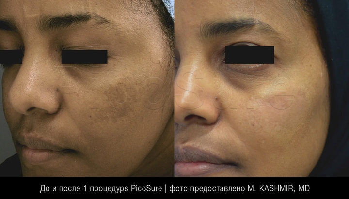 Пігментні плями на обличчі - видалення лазером