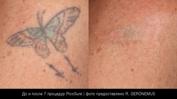 Кольорове татуя на спині, фото до та після видалення лазером PicoSure
