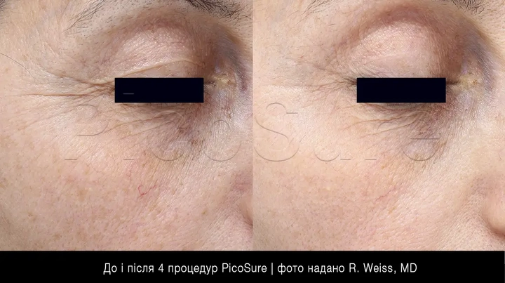 зморшки навколо очей, фото до та після лазерного омолодження PicoSure Focus