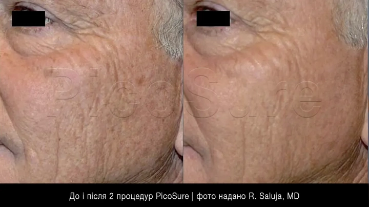 омолодження обличчя PicoSure Focus, фото до та після