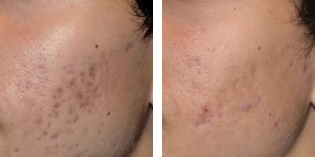 мужчина, постакне на щеках, до и после лечения PcioSure