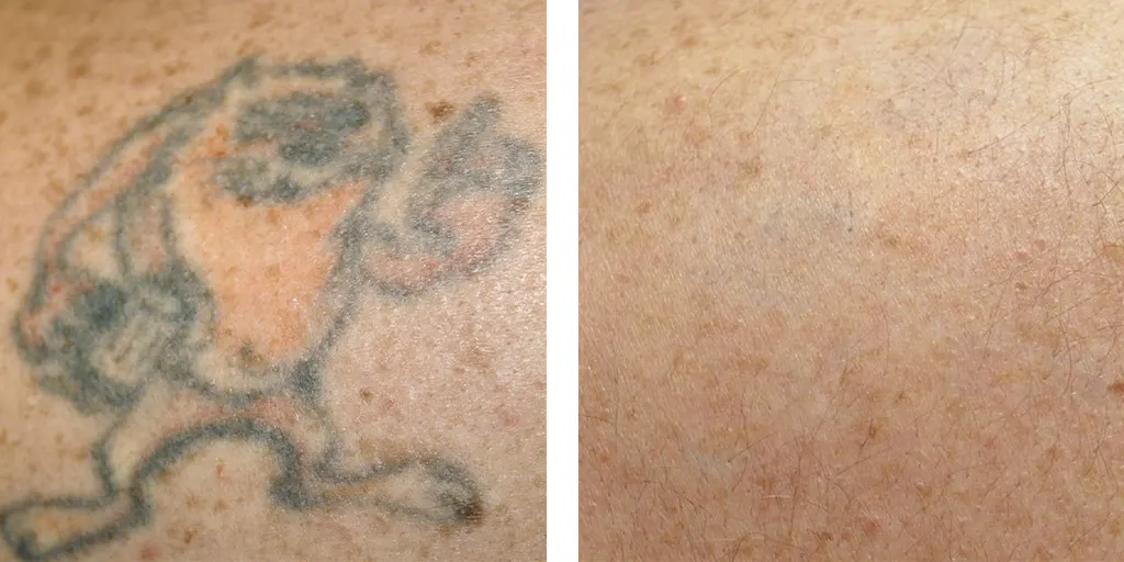 татуировка, до и после удаления PcioSure
