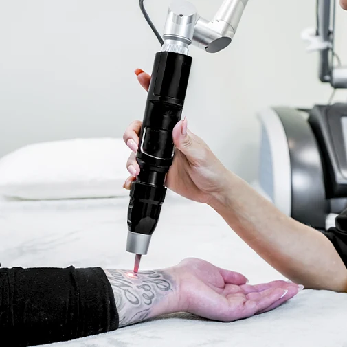 лазер PicoSure, рука пациента, удаление татуировки