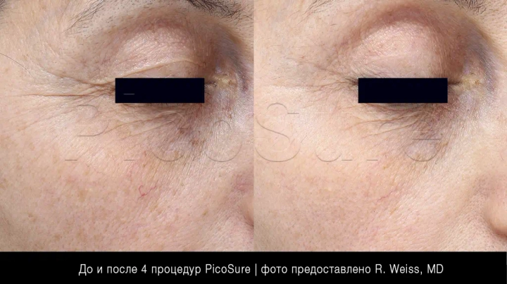 Мелкие морщинки вокруг глаз до и после омоложения PicoSure