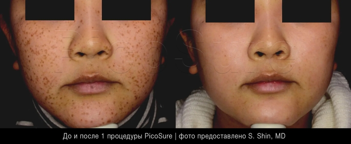 Веснушки на лице. До и после 1 процедуры пикосекундным лазером PicoSure