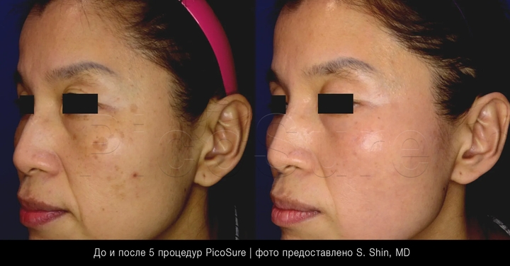 Пигментные пятна на лице - удаление лазером PicoSure
