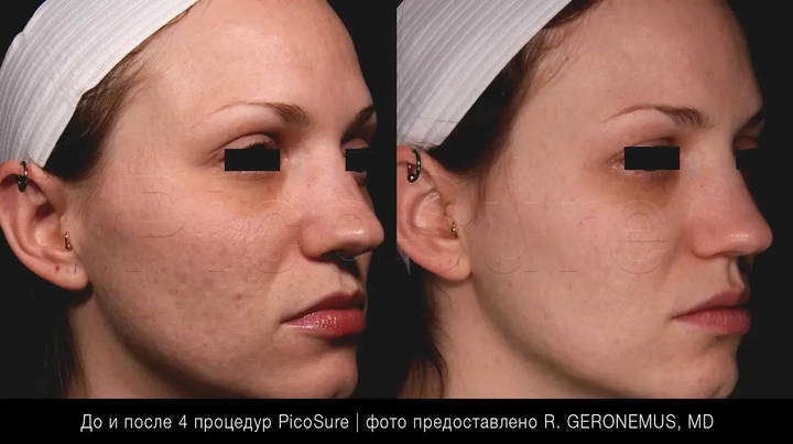 PicoSure лечение постакне, женщина, лицо