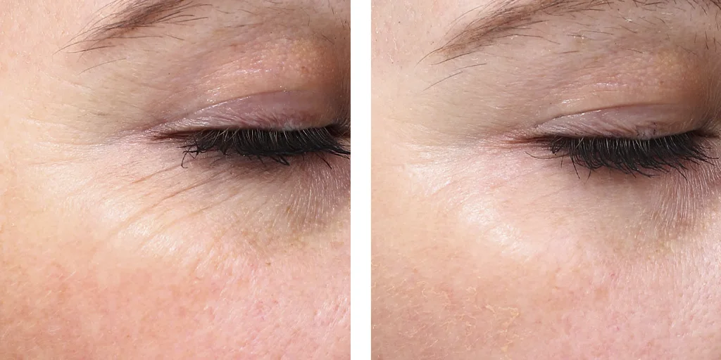 женщина, морщинки вокруг глаз, до и после лечения PcioSure