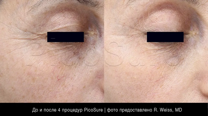 морщинки вокруг глаз, фото до и после лазерного омоложения PicoSure Focus