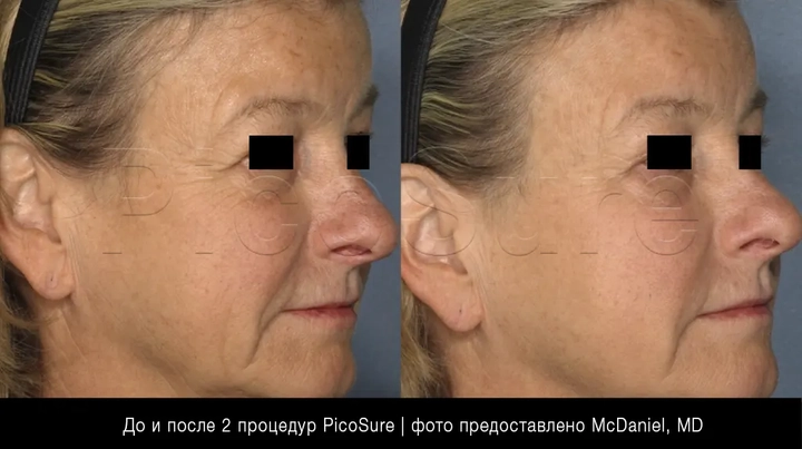 лазерное омоложение лица PicoSure Focus, фото до и после