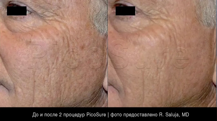 омоложение лица PicoSure Focus, фото до и после